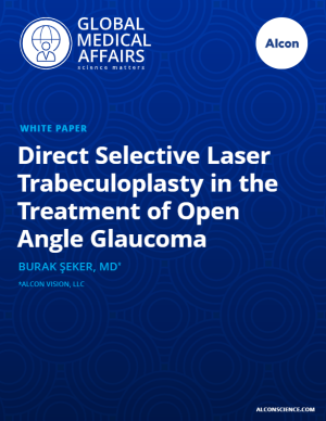 "Direct Selective Laser Trabeculoplasty in the Treatment of Open Angle Glaucoma"