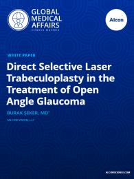 "Direct Selective Laser Trabeculoplasty in the Treatment of Open Angle Glaucoma"