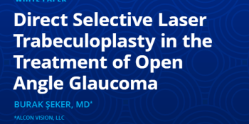 "Direct Selective Laser Trabeculoplasty in the Treatment of Open Angle Glaucoma"